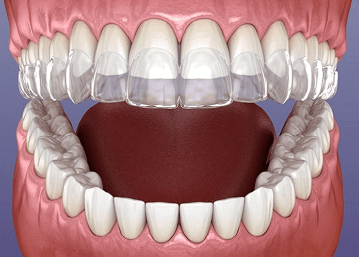 Invisalign clear aligners offered at Lake Pleasant Dentistry